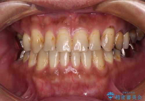 前歯の反対咬合をワイヤー矯正で改善して噛みやすくの症例 治療後