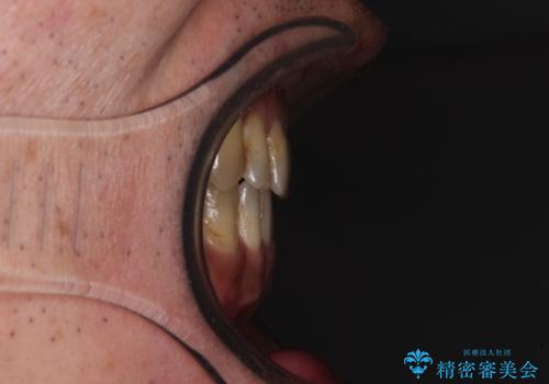 前歯の反対咬合をワイヤー矯正で改善して噛みやすくの治療後