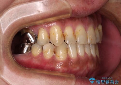 前歯の反対咬合をワイヤー矯正で改善して噛みやすくの治療後