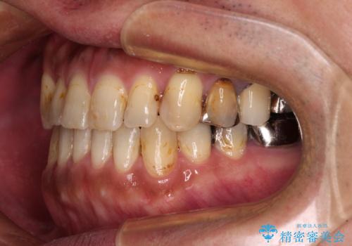 前歯の反対咬合をワイヤー矯正で改善して噛みやすくの治療後