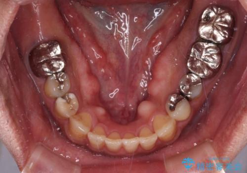 前歯の反対咬合をワイヤー矯正で改善して噛みやすくの治療後