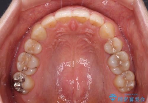 膨らんだ口元が気になる　ワイヤー装置による抜歯矯正の治療後