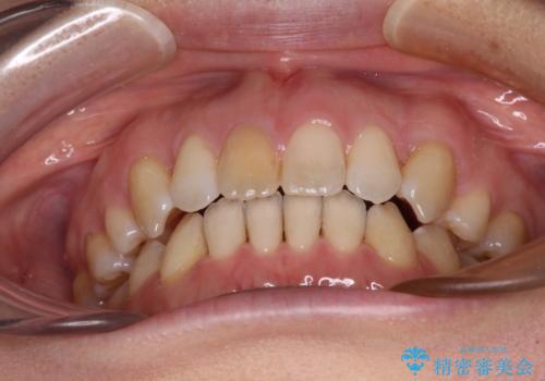 抜歯矯正で閉じにくかった口を閉じやすく改善の治療後