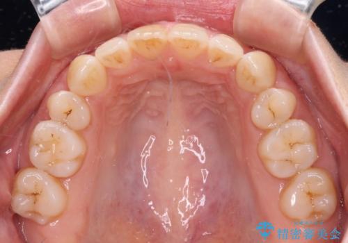 抜歯矯正で閉じにくかった口を閉じやすく改善の治療後