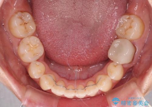 抜歯矯正で閉じにくかった口を閉じやすく改善の治療後