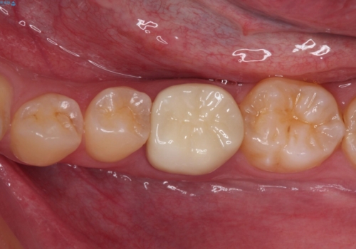 奥歯の被せものが汚れやすい　仮歯のままの歯をセラミッククラウンに