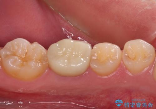 奥歯の被せものが汚れやすい 仮歯のままの歯をセラミッククラウンにの治療後