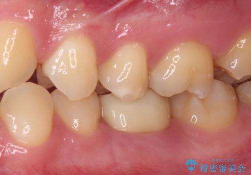 奥歯の被せものが汚れやすい　仮歯のままの歯をセラミッククラウンにの治療後