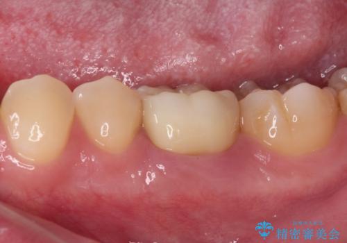 奥歯の被せものが汚れやすい 仮歯のままの歯をセラミッククラウンにの治療後