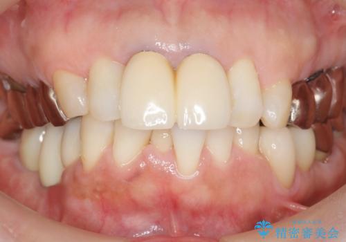 虫歯と歯並びを治したい 50代女性の治療後