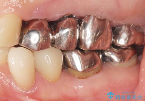 虫歯と歯並びを治したい 50代女性の治療後