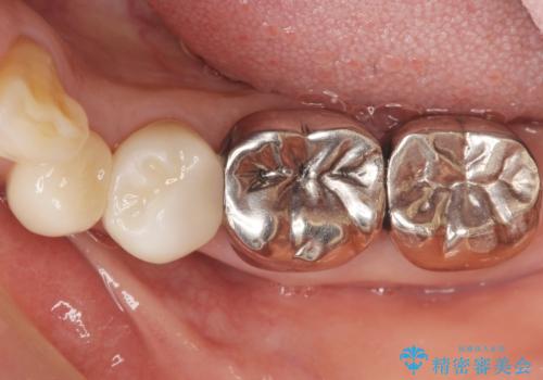 虫歯と歯並びを治したい 50代女性の治療後