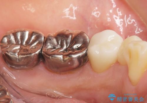 虫歯と歯並びを治したい 50代女性の治療後