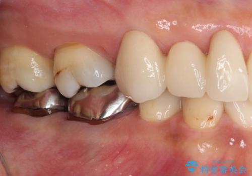 欠損の多い歯列 部分矯正とセラミックブリッジで自然な見た目にの治療後