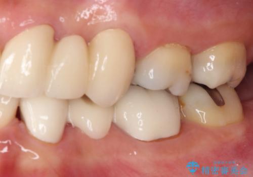 欠損の多い歯列 部分矯正とセラミックブリッジで自然な見た目にの治療後
