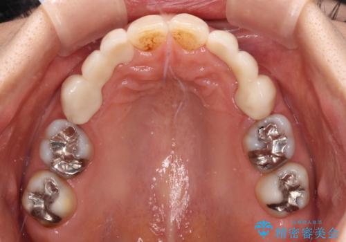 欠損の多い歯列　部分矯正とセラミックブリッジで自然な見た目にの治療後
