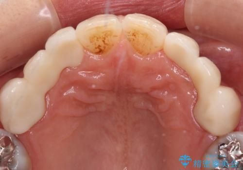 欠損の多い歯列 部分矯正とセラミックブリッジで自然な見た目にの治療後