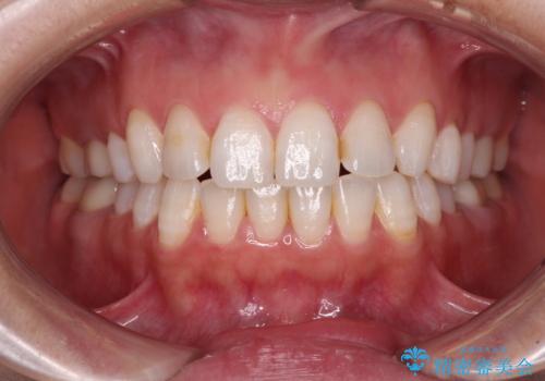 目立つ銀歯を白くしたい 奥歯のセラミック治療の治療後