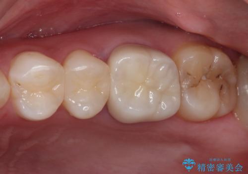 目立つ銀歯を白くしたい 奥歯のセラミック治療の治療後