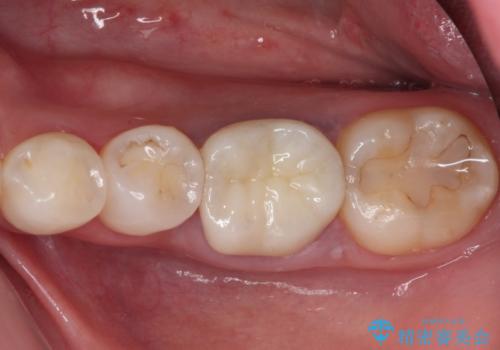 目立つ銀歯を白くしたい　奥歯のセラミック治療の治療後