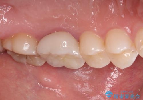 目立つ銀歯を白くしたい 奥歯のセラミック治療の治療後