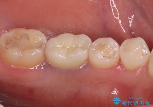 目立つ銀歯を白くしたい 奥歯のセラミック治療の治療後