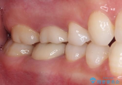 目立つ銀歯を白くしたい 奥歯のセラミック治療の治療後