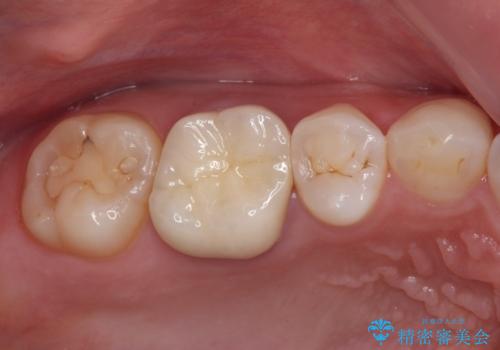 目立つ銀歯を白くしたい 奥歯のセラミック治療の治療後