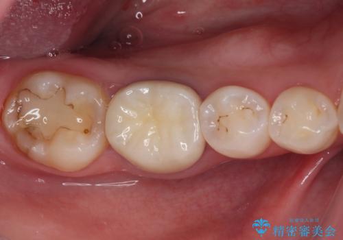 目立つ銀歯を白くしたい　奥歯のセラミック治療の治療後