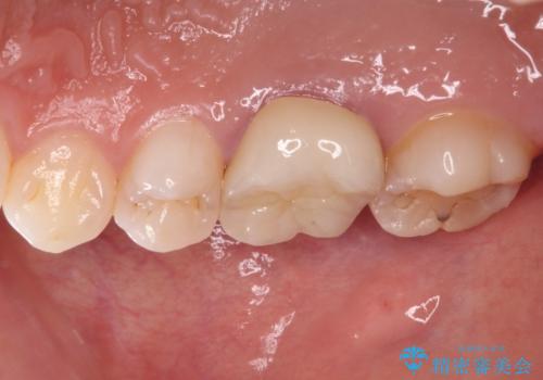 目立つ銀歯を白くしたい 奥歯のセラミック治療の治療後