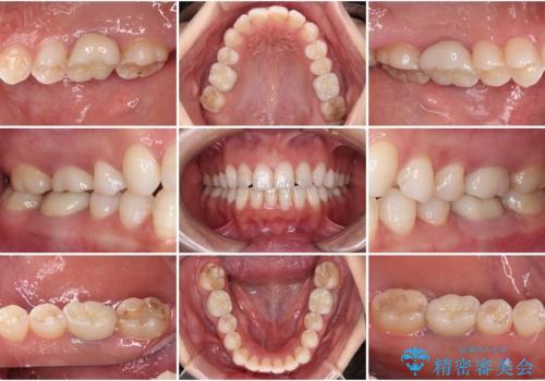 目立つ銀歯を白くしたい 奥歯のセラミック治療の症例 治療後