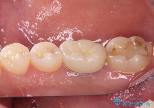 目立つ銀歯を白くしたい 奥歯のセラミック治療の治療後