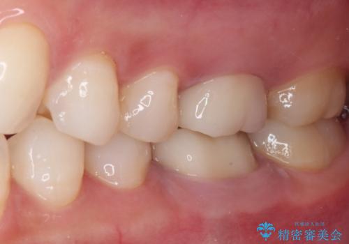 目立つ銀歯を白くしたい 奥歯のセラミック治療の治療後