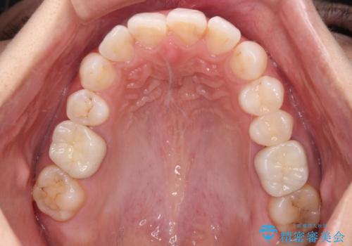 目立つ銀歯を白くしたい 奥歯のセラミック治療の治療後