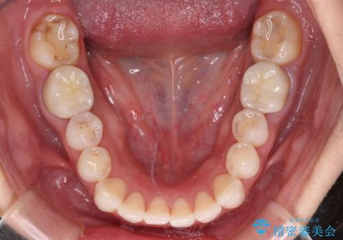 目立つ銀歯を白くしたい 奥歯のセラミック治療の治療後