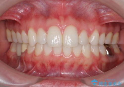 インビザラインで 抜歯矯正の治療後