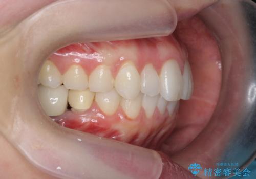 インビザラインで 抜歯矯正の治療後