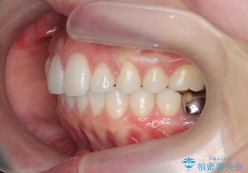 インビザラインで 抜歯矯正の治療後