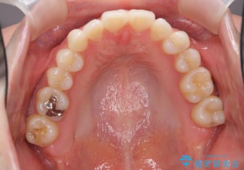 インビザラインで 抜歯矯正の症例 治療後