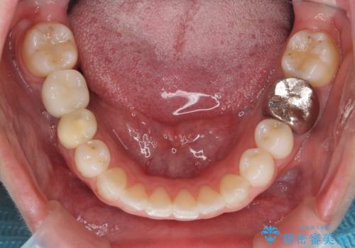 インビザラインで 抜歯矯正の治療後