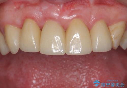 前歯の虫歯　つぎはぎの歯をセラミックにの症例 治療後