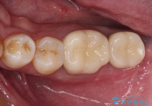 抜歯が必要な奥歯　ストローマン・インプラント補綴治療の治療後