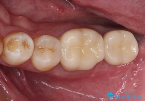 抜歯が必要な奥歯　ストローマン・インプラント補綴治療