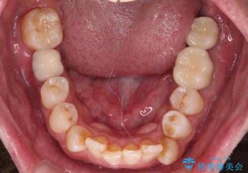 抜歯が必要な奥歯　ストローマン・インプラント補綴治療の治療後