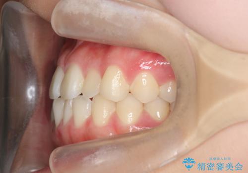 ガタつきの改善 マウスピース矯正治療の治療前