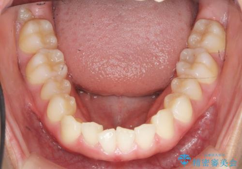 ガタつきの改善 マウスピース矯正治療の治療前