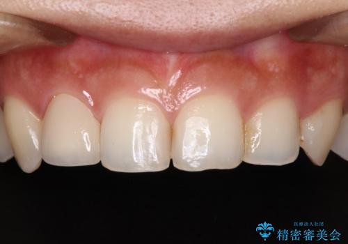 むし歯だらけの歯を治したい インプラントを用いた補綴治療