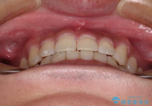 隙間の空いた前歯を治したい 上顎の部分矯正の治療後