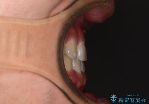 隙間の空いた前歯を治したい 上顎の部分矯正の治療後