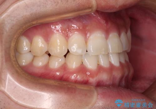 隙間の空いた前歯を治したい 上顎の部分矯正の治療後